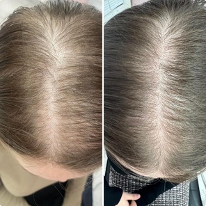 Гнездная алопеция