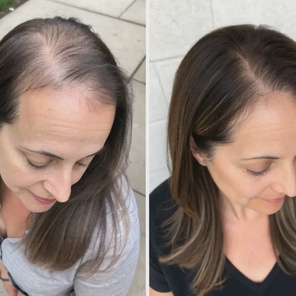 Андрогенетическая алопеция