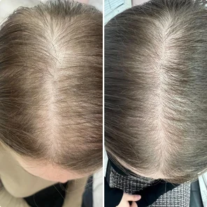 Гнездная алопеция